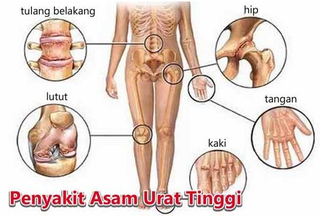 Illustration for article titled Obat Tradisional Penyakit Asam Urat